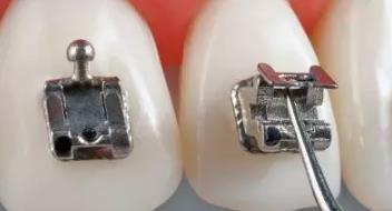 自鎖托槽矯正價(jia) 格