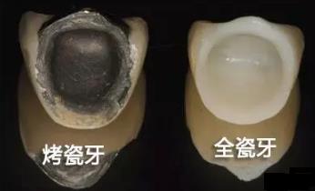 什麽(me) 是口腔全瓷牙