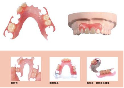 鑲活動義(yi) 齒修複