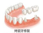 烤瓷牙鑲牙多少錢