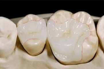 深圳醫院補牙多少錢一顆