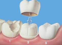 牙齒修複體(ti) 有哪些種類