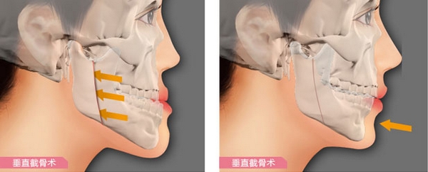 正頜手術價(jia) 格怎麽(me) 樣