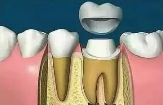 根管治療後牙齒能用多久