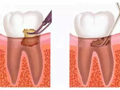 牙周刮治去除牙結石