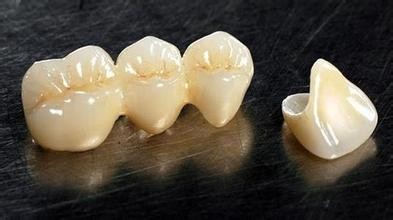 烤瓷牙會(hui) 掉下來嗎