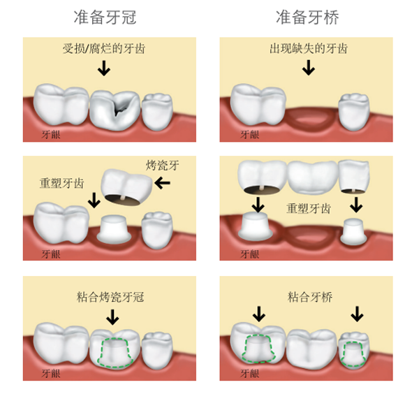 烤瓷牙冠取下後需要重新製作嗎