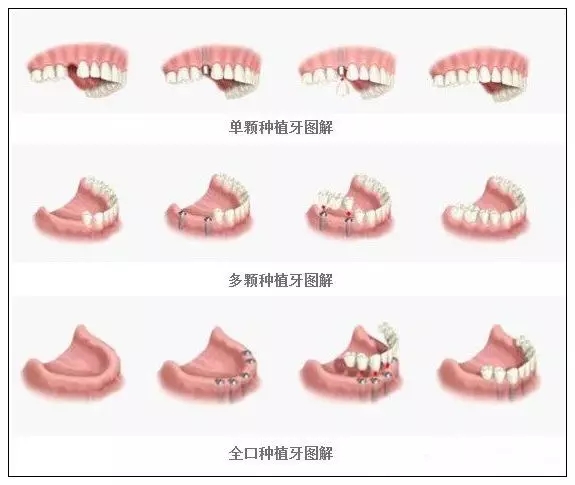 種牙幾天拆線比較好