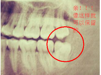 拔除智齒有沒有危害