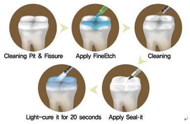 口腔窩溝封閉術後多久複查