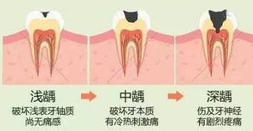 蛀牙的詳細分類情況和分類標準