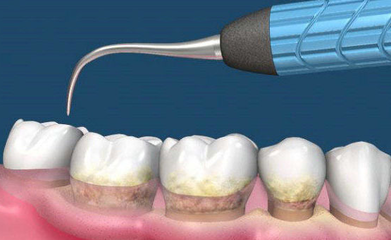 洗牙哪種技術好