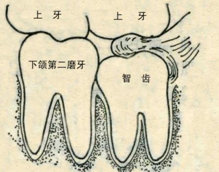 智齒發炎的原因