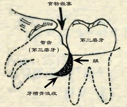 先洗牙還是先拔牙