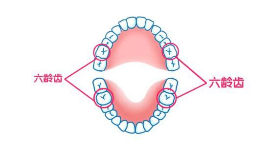 四顆六齡齒需要做窩溝封閉