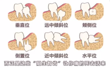 阻生智齒要不要拔除