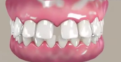 牙縫大牙齒矯正前