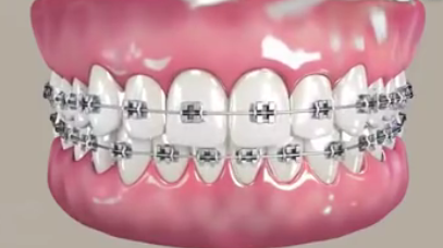 牙縫大牙齒矯正後