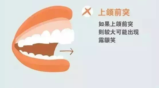 露齦笑的情況