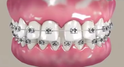 牙齒矯正有優(you) 惠嗎