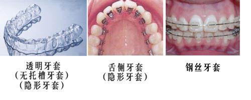矯正牙齒的牙套