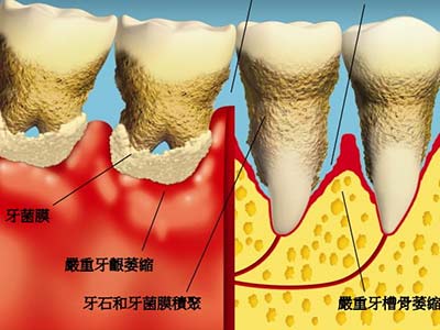年輕人牙齦萎縮的原因