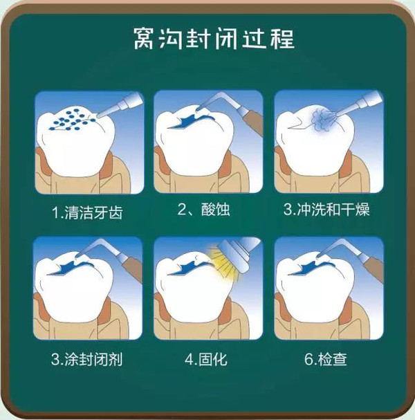 窩溝封閉的過程