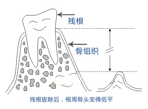 殘根拔還是不拔