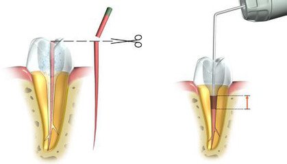 影響根管治療壽命的原因