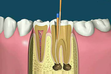 根管治療價(jia) 格
