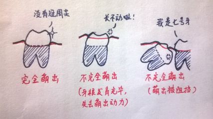 長智齒疼嗎
