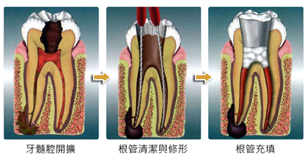 根管治療後疼痛