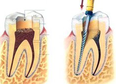 兒(er) 童根管治療要注意什麽(me)