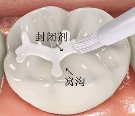 塗氟 窩溝封閉