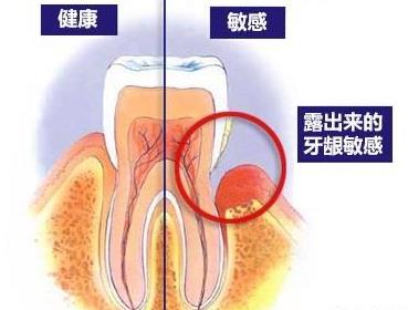 洗牙後牙齒敏感