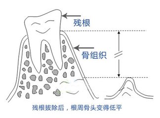 殘根有什麽(me) 危害