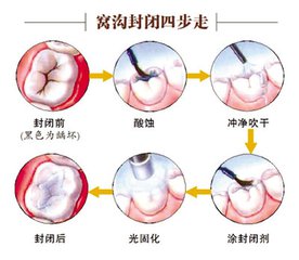 虎牙要做窩溝封閉嗎