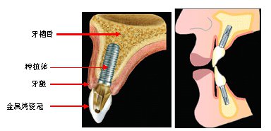 牙掉了種牙的條件