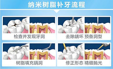 補牙充填步驟