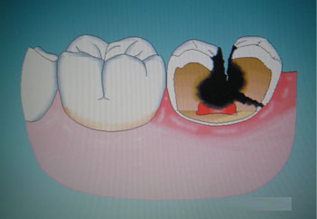 齲齒要不要殺牙神經需要看檢查結果