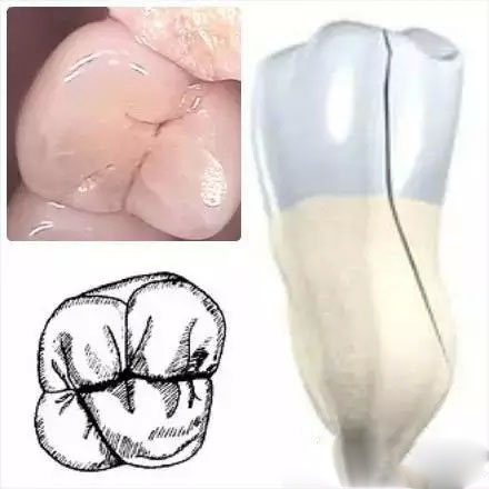 牙隱裂會(hui) 恢複嗎