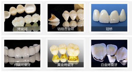 烤瓷牙材料不同價(jia) 格不同