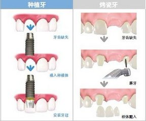 烤瓷牙和種植牙價(jia) 格