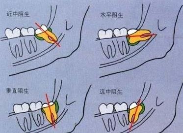 拔智齒的價(jia) 格