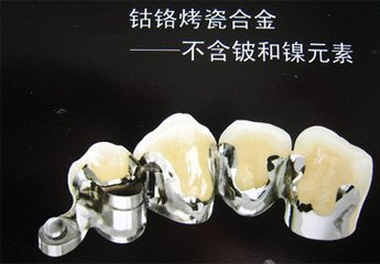 鈷鉻烤瓷牙能用多久