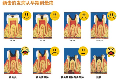 小孩蛀牙牙疼怎麽(me) 辦，要不要做根管治療
