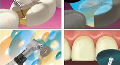 光固化樹脂補牙