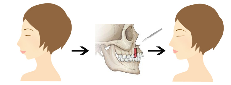 兒(er) 童牙齒不齊怎麽(me) 矯正