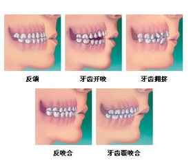 矯正齙牙要拔牙嗎