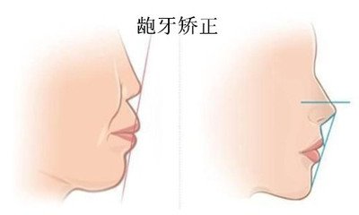 齙牙矯正後結果